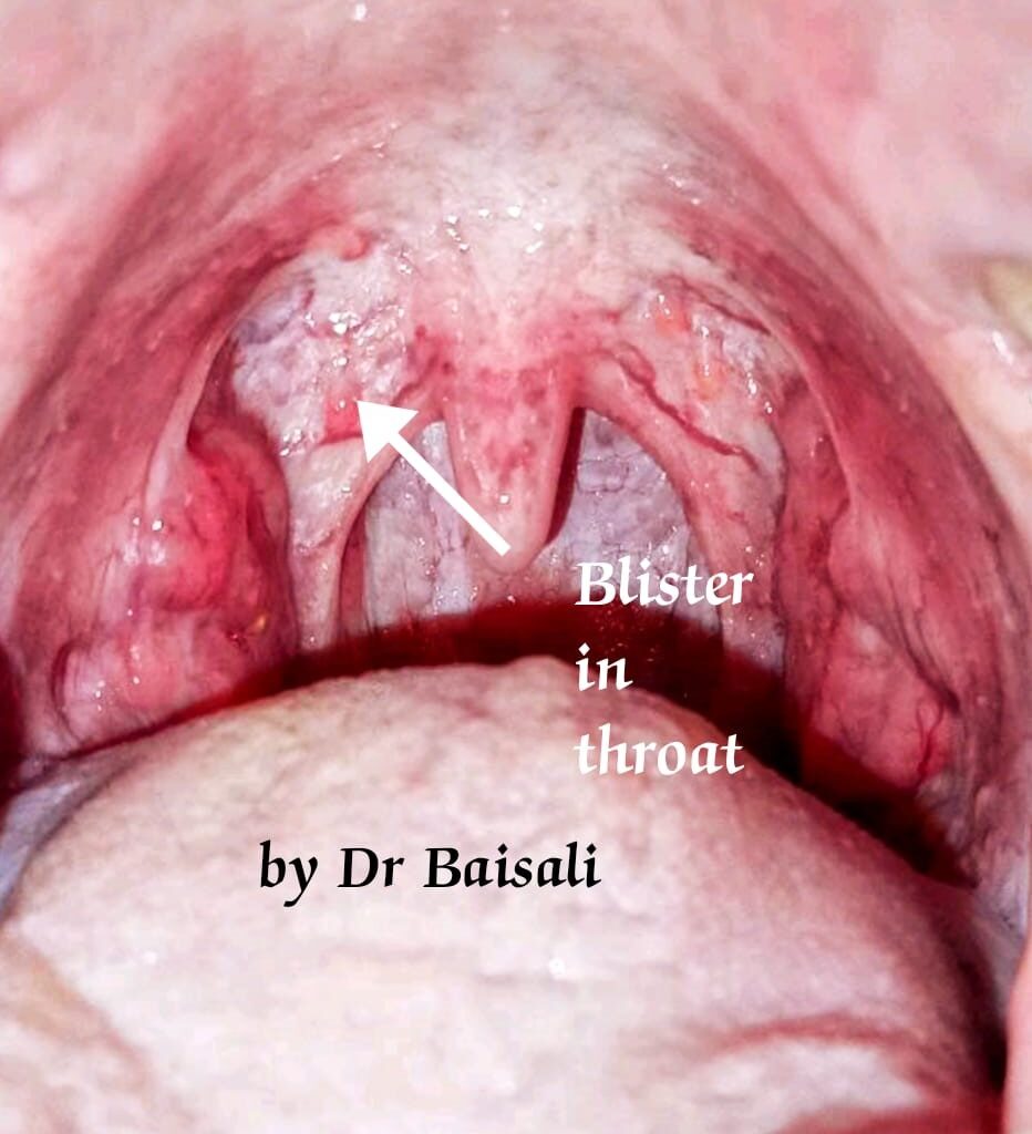 what causes blisters in throat