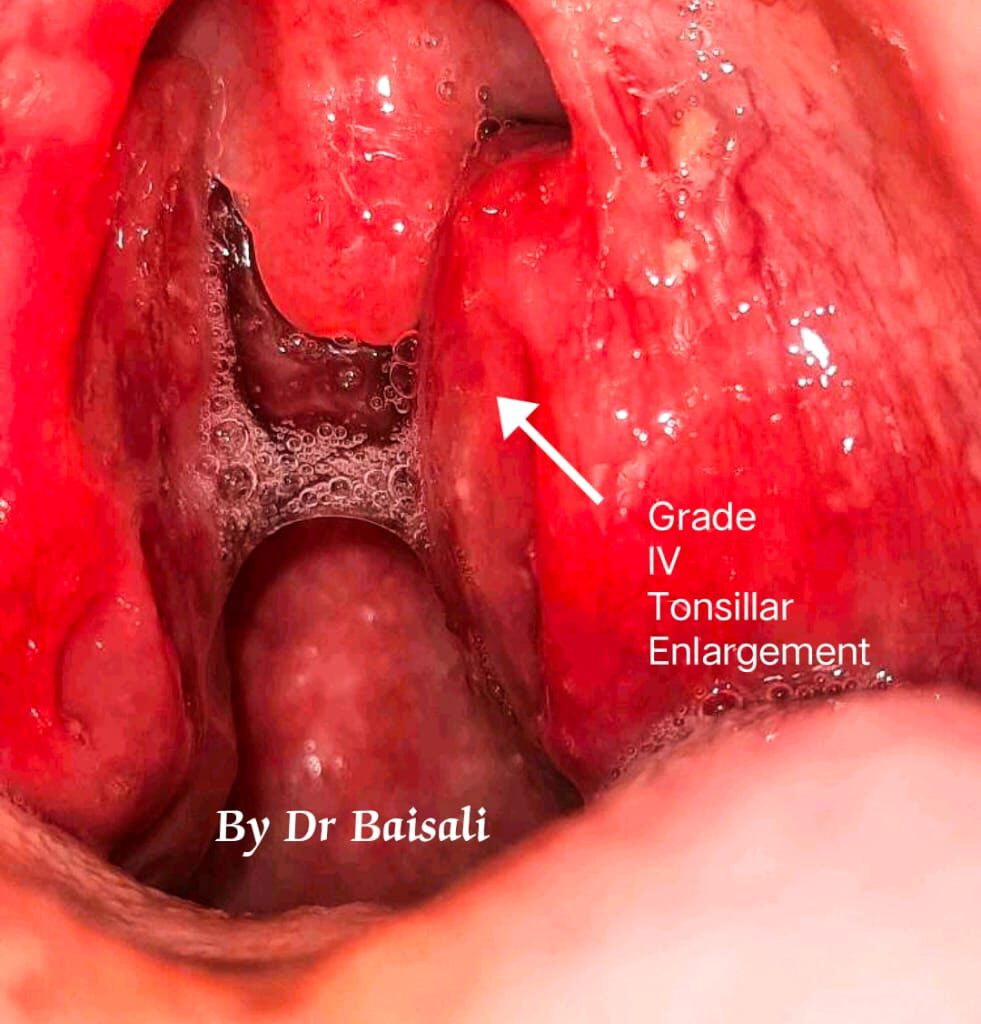 tonsillitis grading